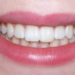 after-clear-braces