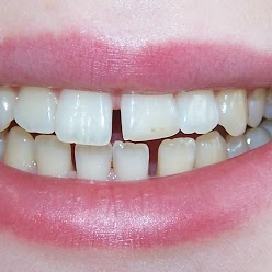 before-clear-braces