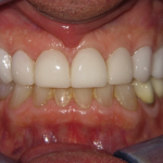 After Cosmetic Dentistry