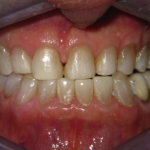 Before Cosmetic Dentistry