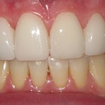 After Cosmetic Dentistry