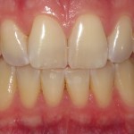 Before Cosmetic Dentistry