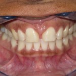 Before Cosmetic Dentistry