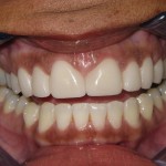 After Cosmetic Dentistry