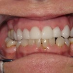 After Cosmetic Dentistry