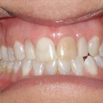 Before Cosmetic Dentistry