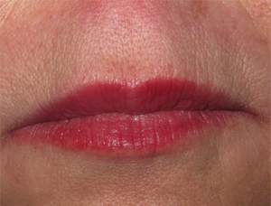 After Dermal Fillers