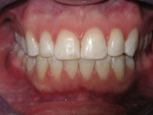 After Invisalign