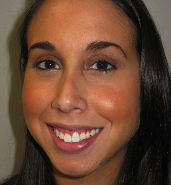 Before-Botox-Gummy-Smile-Correction Before Botox for Gummy Smile