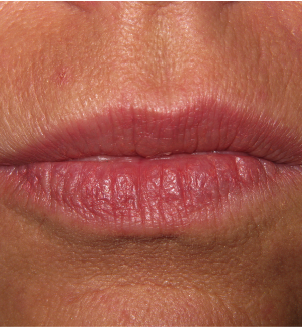 Before Juvederm Filler Around the Mouth & Lips Before Dermal Fillers