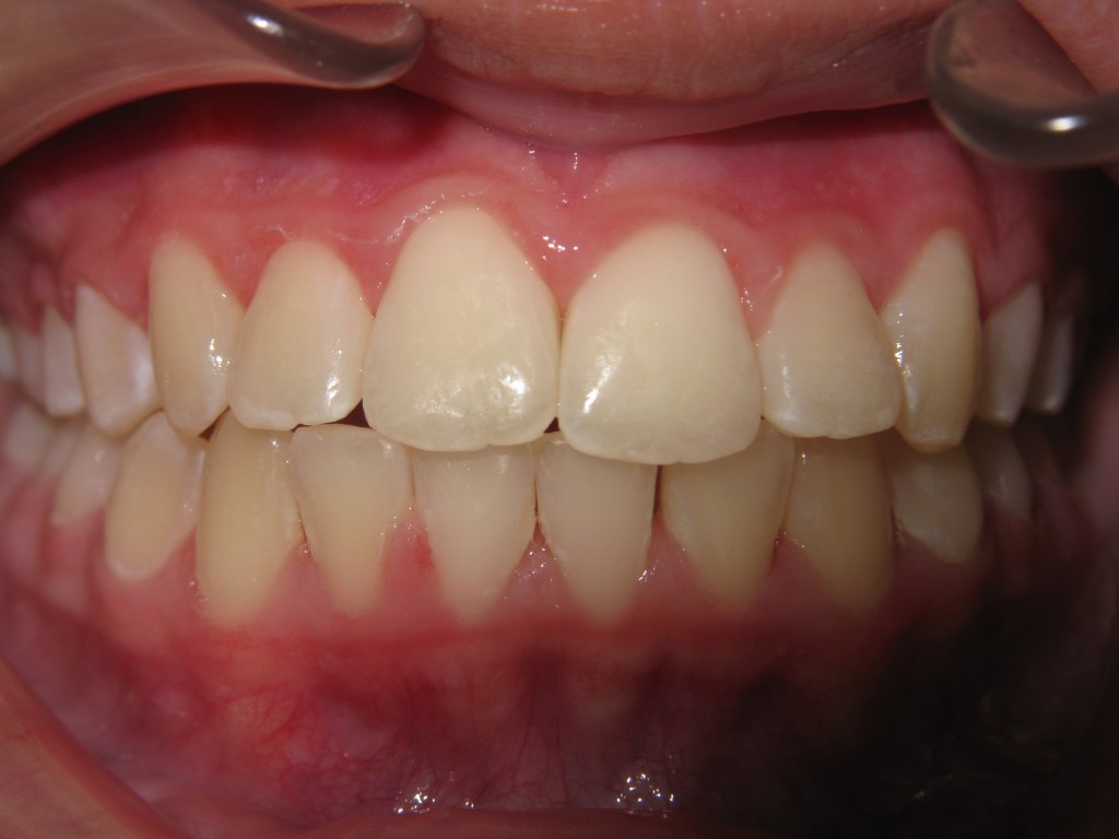 after Invisalign