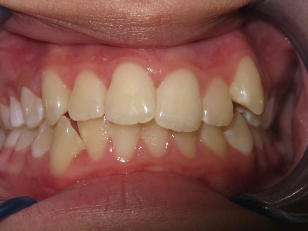 before Invisalign