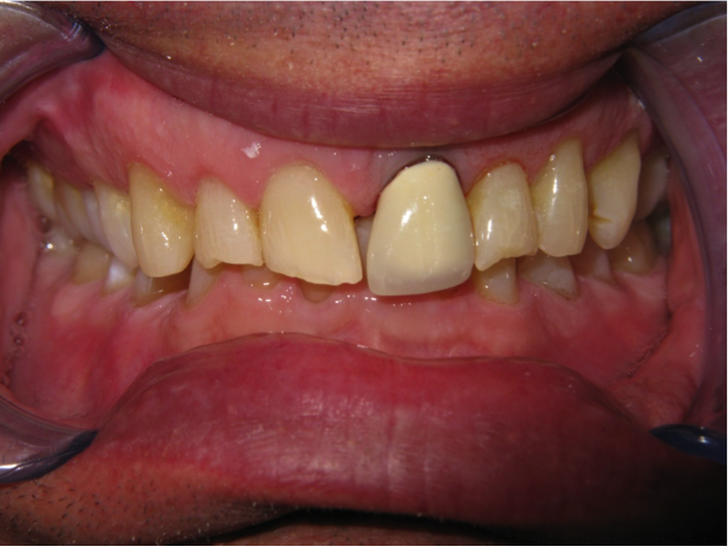 Before Porcelain Crowns