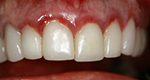 porcelain veneers hinsdale