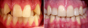 invisalign-severe-crowding