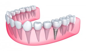 Oak Brook dental implants