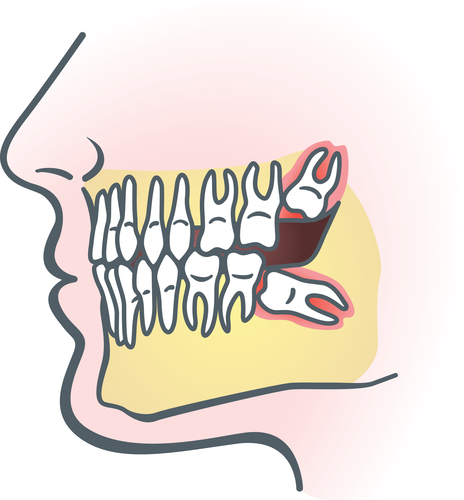 Westmont tooth extraction