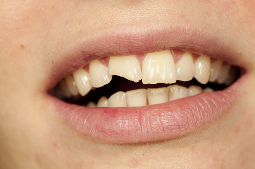 woman with a chipped incisor in need of Western Springs chipped tooth repair