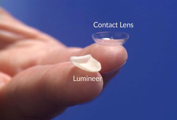 graphic showing the thickness of Hinsdale Lumineers as compared to a contact lens