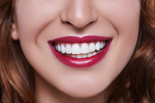 care for your veneers