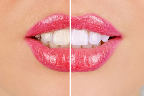 woman teeth before and after whitening