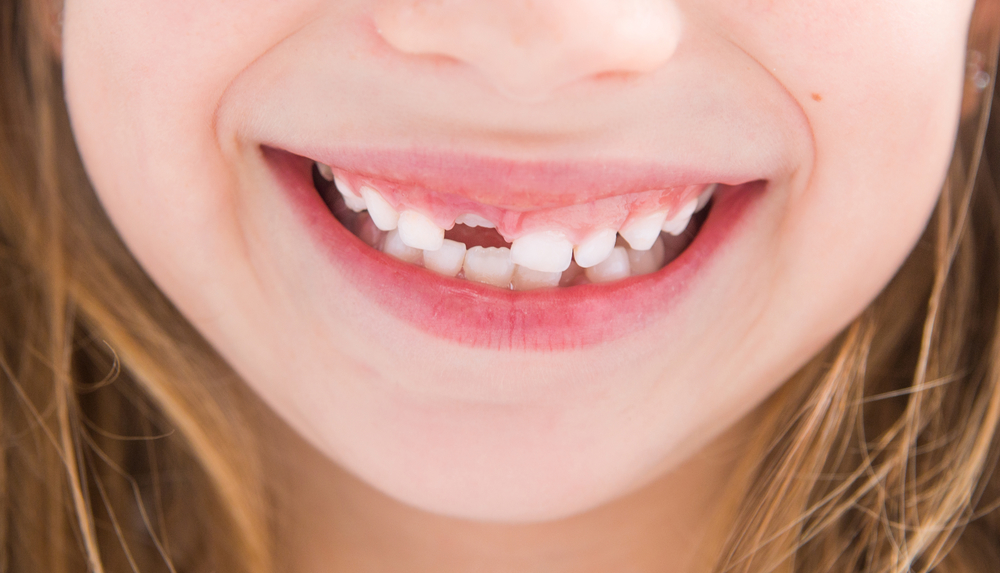 girl smiling showing teeth