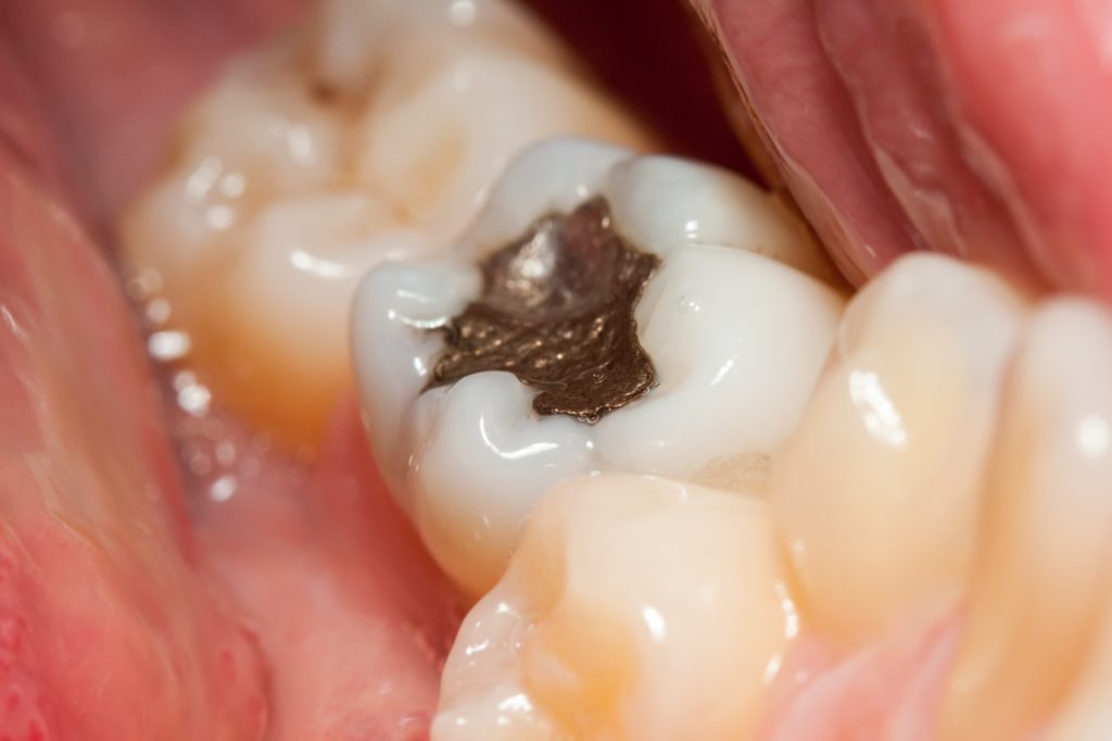 Replacing Mercury Fillings