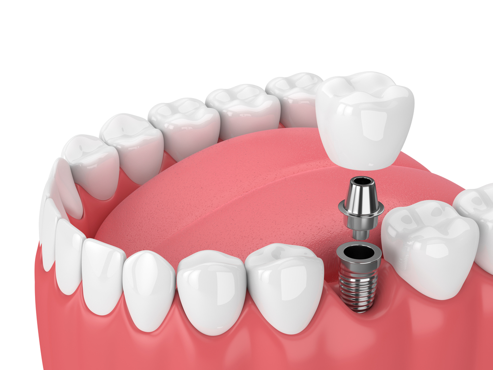 Long-term dental implant benefits