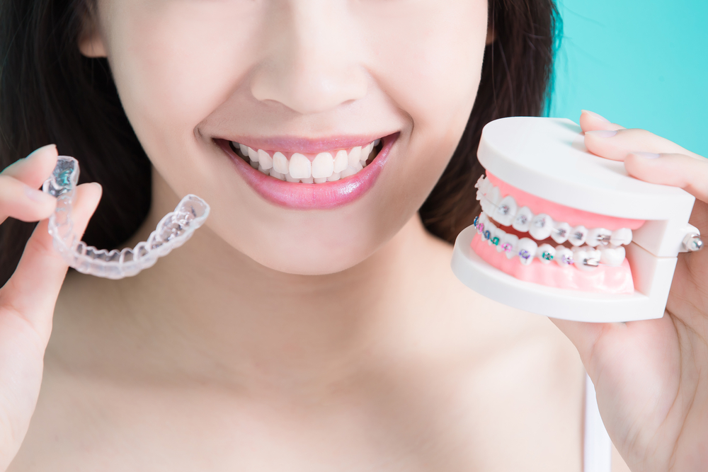 Invisalign vs braces for adults