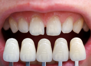 Choosing Lumineers veneers for chipped, uneven, short teeth. 