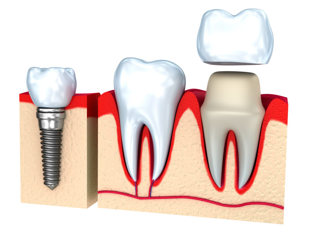 Image of healthy tooth, dental crown, and dental implant.
