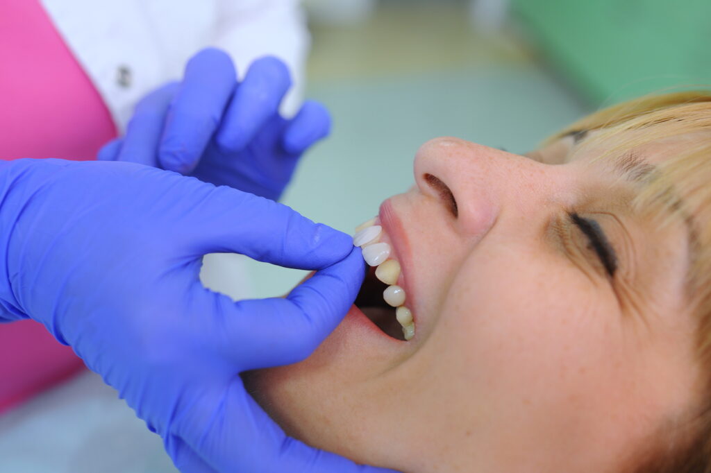 Dentist placing Lumineers