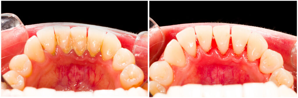 Tartar on teeth before and after.