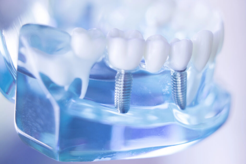 Model of dental implants showing titanium post and crown.