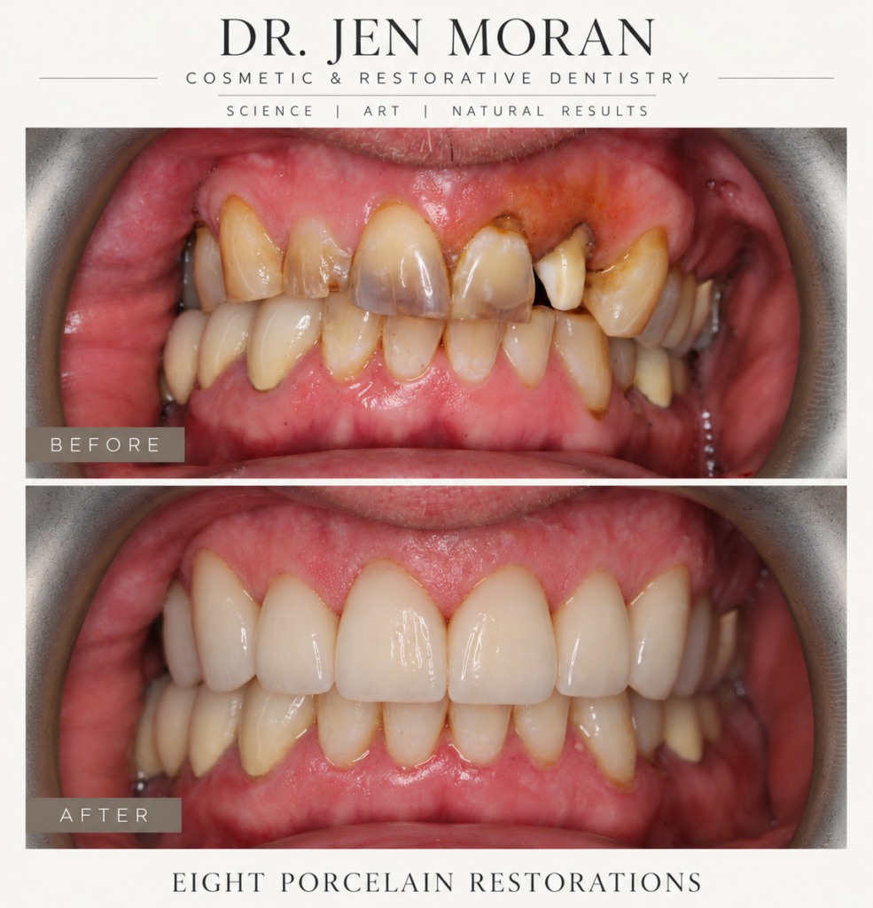 before and after crowns dr moran